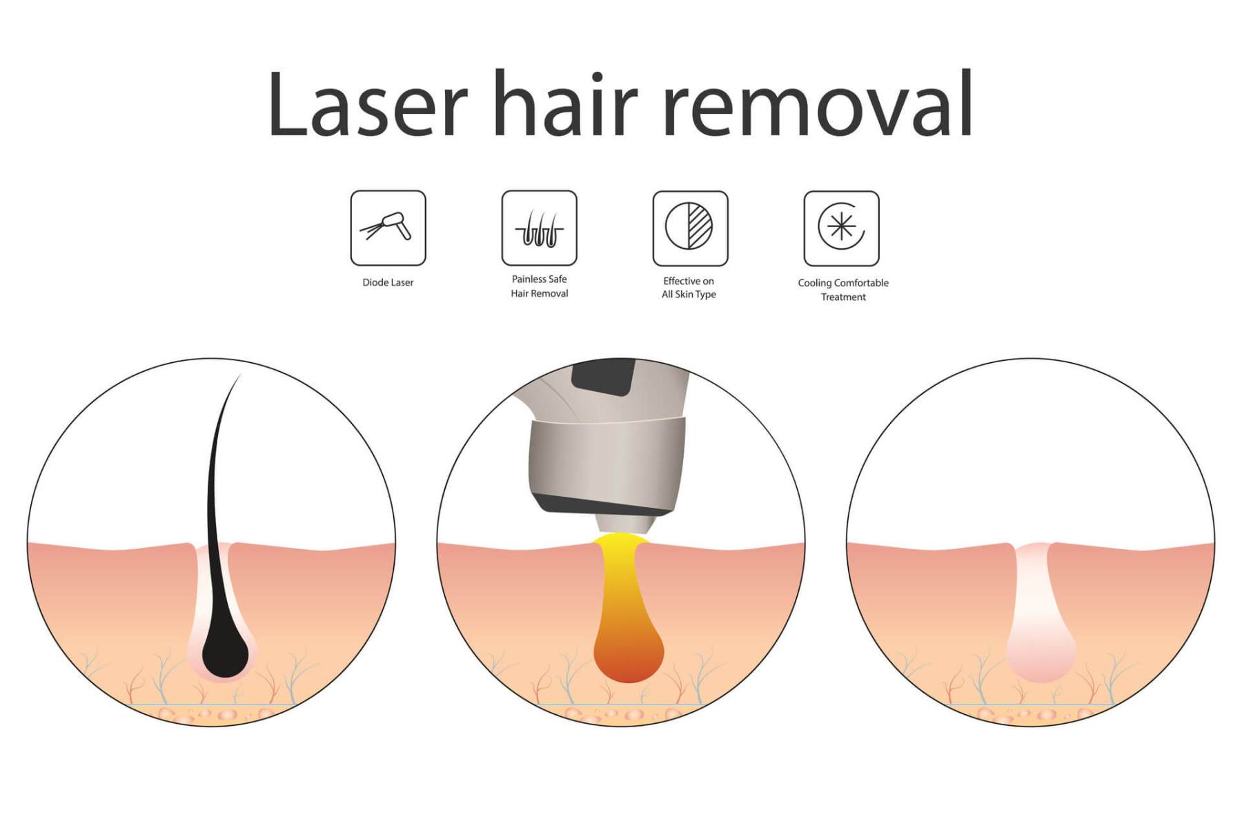 1_The-Laser-Hair-Removal-Procedure