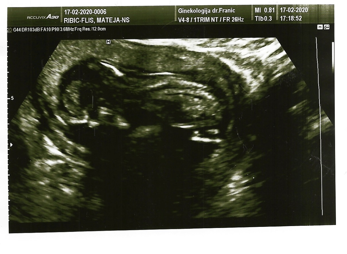 baby-in-abdomen-fetal-ultrasound